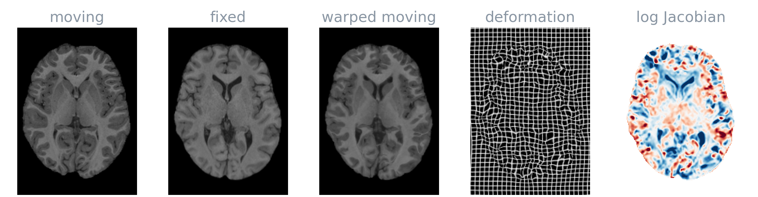 A brain MRI pair registered with TransMorph-TVF: moving, fixed, warped moving, deformed grid and log Jacobian determinant